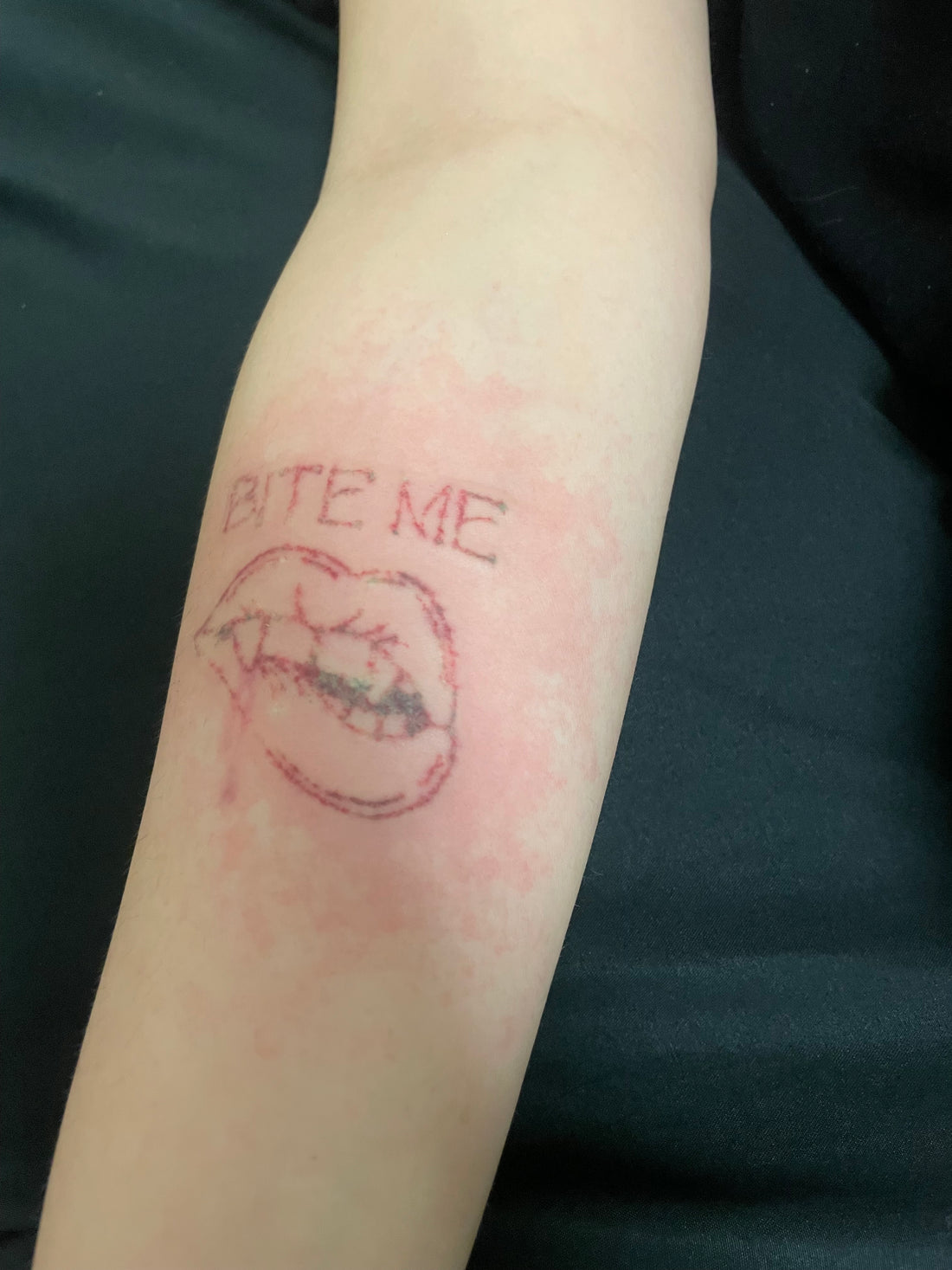 Laser Tattoo Removal